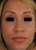Patient # 15265 After Photo # 2